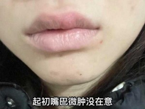 乳房头被老嘴咬了肿了怎么办？试试[产品名称]，快速消肿止痛