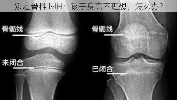 家庭骨科 lvlH：孩子身高不理想，怎么办？